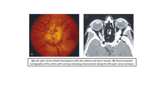 (a) Left optic nerve sheath meningioma with disc edema and shunt vessels. (b) Axial computed
tomography of the orbits with contrast showing enhancement along the left optic nerve (arrows).
 