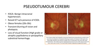 PSEUDOTUMOUR CEREBRI
• P/K/A- Benign intracranial
hypertension.
• Raised ICT w/o presence of ICSOL
• Obese females (20s-30s)
• Transient blurring of vision and
photopsia.
• Loss of visual function (High grade or
atrophic papilledema or peripapillary
subretinal hemorrhage.
This 10-year-old girl with idiopathic intracranial hypertension (pseudotumor cerebri) had a
recurrence of symptoms of headache following cessation of treatment. Both optic discs
show slight elevation and indistinct margins due to thickening of the nerve fiber layer
around the disc. The lumbar puncture opening pressure was 35 cm of CSF. Visual acuity and
color vision were normal. The visual fields showed marginally enlarged blind spots.
 