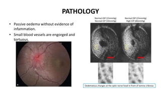 PATHOLOGY
• Passive oedema without evidence of
infammation.
• Small blood vessels are engorged and
tortuous.
Oedematous changes at the optic nerve head in front of lamina cribrosa.
 