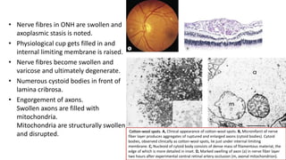 • Nerve fibres in ONH are swollen and
axoplasmic stasis is noted.
• Physiological cup gets filled in and
internal limiting membrane is raised.
• Nerve fibres become swollen and
varicose and ultimately degenerate.
• Numerous cystoid bodies in front of
lamina cribrosa.
• Engorgement of axons.
Swollen axons are filled with
mitochondria.
Mitochondria are structurally swollen
and disrupted. Cotton-wool spots. A, Clinical appearance of cotton-wool spots. B, Microinfarct of nerve
fiber layer produces aggregates of ruptured and enlarged axons (cytoid bodies). Cytoid
bodies, observed clinically as cotton-wool spots, lie just under internal limiting
membrane. C, Nucleoid of cytoid body consists of dense mass of filamentous material, the
edge of which is more detailed in inset. D, Marked swelling of axon (a) in nerve fiber layer
two hours after experimental central retinal artery occlusion (m, axonal mitochondrion).
 