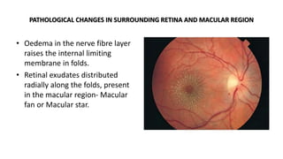 PATHOLOGICAL CHANGES IN SURROUNDING RETINA AND MACULAR REGION
• Oedema in the nerve fibre layer
raises the internal limiting
membrane in folds.
• Retinal exudates distributed
radially along the folds, present
in the macular region- Macular
fan or Macular star.
 
