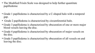Comprehensive Overview of Papilledema and Idiopathic Intracranial ...