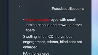 z
Pseudopapilloedema
 Hypermetropic eyes with small
lamina cribosa and crowded nerve
fibers
Swelling isnot >2D, no venous
engorgement, edema, blind spot not
enlarged
FA – no leakage
 