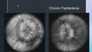 z
Chronic Papilledema
 
