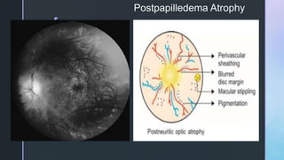z
Postpapilledema Atrophy
 