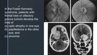 z
In the Foster Kennedy
syndrome, patients with
frontal lobe or olfactory
groove tumors develop the
triad of
(a) optic atrophy in one eye;
(b) papilledema in the other
eye; and
(c) anosmia
 