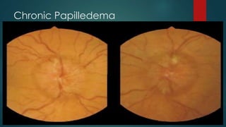Chronic Papilledema
 