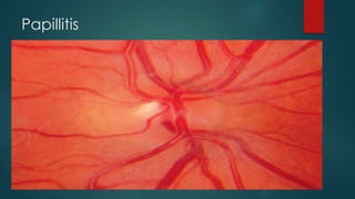 Papillitis
 