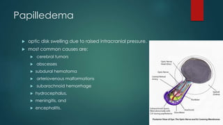 Papilledema
 optic disk swelling due to raised intracranial pressure.
 most common causes are:
 cerebral tumors
 abscesses
 subdural hematoma
 arteriovenous malformations
 subarachnoid hemorrhage
 hydrocephalus,
 meningitis, and
 encephalitis.
 