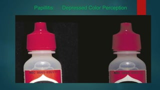 Papillitis: Depressed Color Perception
 
