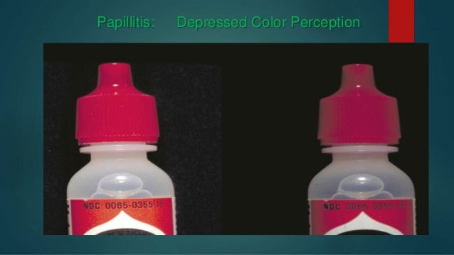 papillitis