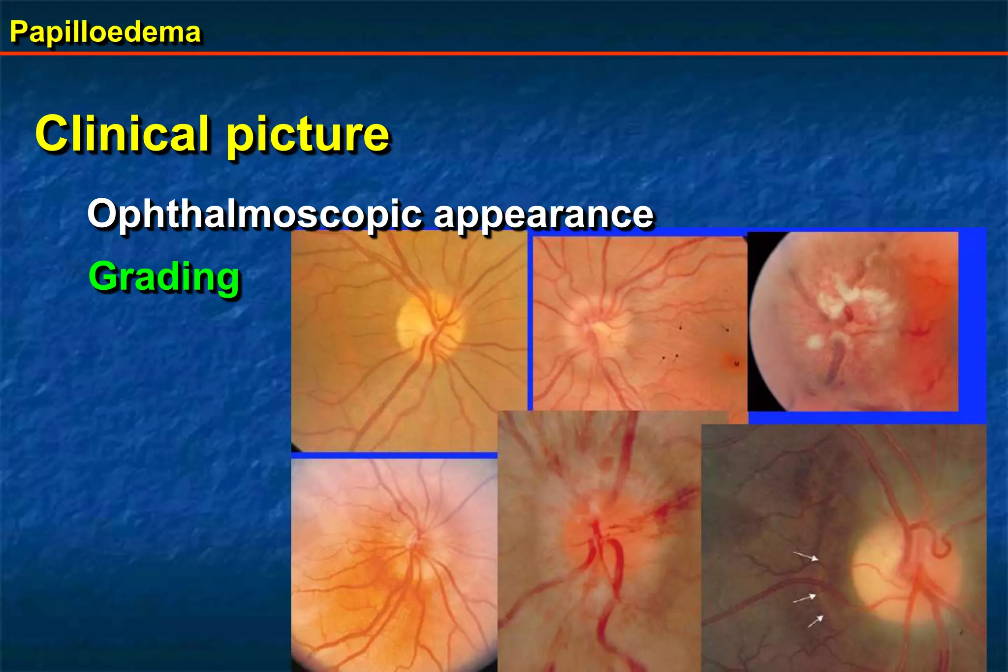 Papilloedema
Clinical picture
Ophthalmoscopic appearance
Grading
 