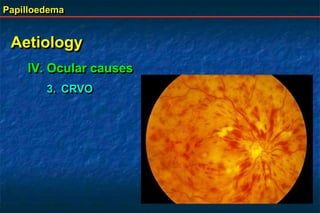 Papilloedema
Aetiology
IV. Ocular causes
3. CRVO
 