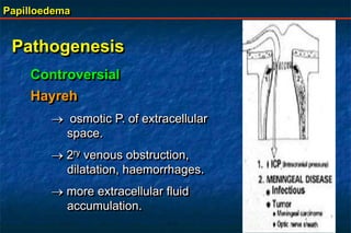 Papilloedema
Pathogenesis
Controversial
Hayreh
 osmotic P. of extracellular
space.
 2ry venous obstruction,
dilatation, haemorrhages.
 more extracellular fluid
accumulation.
 