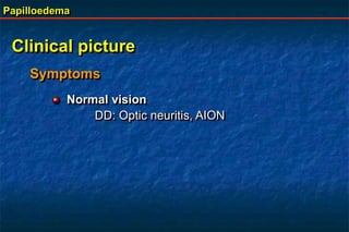 Papilloedema
Clinical picture
Symptoms
Normal vision
DD: Optic neuritis, AION
 