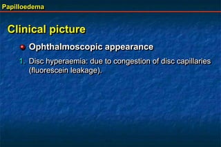Papilloedema
Clinical picture
Ophthalmoscopic appearance
1. Disc hyperaemia: due to congestion of disc capillaries
(fluorescein leakage).
 
