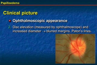 Papilloedema
Clinical picture
Ophthalmoscopic appearance
2. Disc elevation (measured by ophthalmoscope) and
increased diameter  blurred margins, Paton’s lines.
 