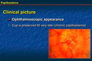 Papilloedema
Clinical picture
Ophthalmoscopic appearance
3. Cup is preserved till very late (chronic papilloedema).
 