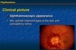 Papilloedema
Clinical picture
Ophthalmoscopic appearance
4. MA, splinter haemorrhages at the disc and
peripapillary retina.
 