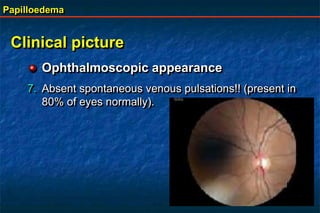 Papilloedema
Clinical picture
Ophthalmoscopic appearance
7. Absent spontaneous venous pulsations!! (present in
80% of eyes normally).
 