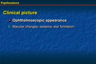 Papilloedema
Clinical picture
Ophthalmoscopic appearance
8. Macular changes: oedema, star formation.
 