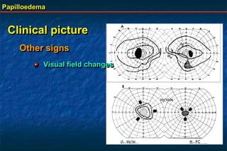 Papilloedema
Clinical picture
Visual field changes
Other signs
 