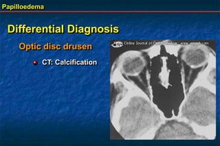 Papilloedema
Differential Diagnosis
Optic disc drusen
CT: Calcification
 