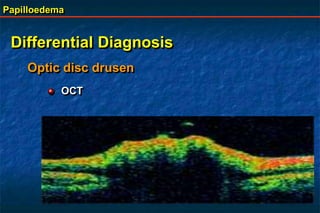 Papilloedema
Differential Diagnosis
Optic disc drusen
OCT
 