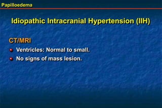 Papilloedema
CT/MRI
Ventricles: Normal to small.
No signs of mass lesion.
Idiopathic Intracranial Hypertension (IIH)
 