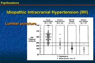 Papilloedema
Lumbar puncture
Idiopathic Intracranial Hypertension (IIH)
 