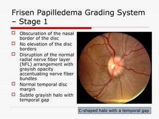 Papilloedema and Optic Atrophy-optha.ppt
