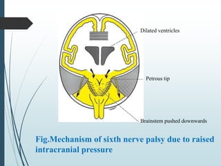 Fig.Mechanism of sixth nerve palsy due to raised
intracranial pressure
Dilated ventricles
Petrous tip
Brainstem pushed downwards
 