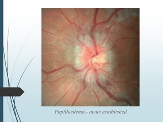 Papilloedema.- acute established
 