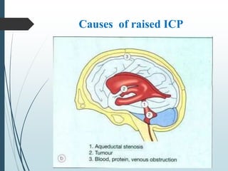 Causes of raised ICP
 