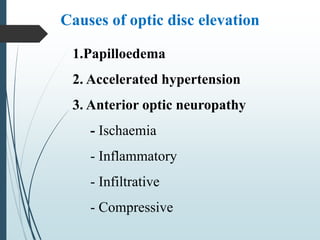 Causes of optic disc elevation
1.Papilloedema
2. Accelerated hypertension
3. Anterior optic neuropathy
- Ischaemia
- Inflammatory
- Infiltrative
- Compressive
 