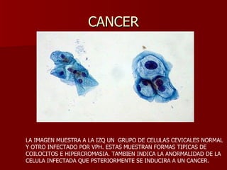 CANCER LA IMAGEN MUESTRA A LA IZQ UN  GRUPO DE CELULAS CEVICALES NORMAL Y OTRO INFECTADO POR VPH. ESTAS MUESTRAN FORMAS TIPICAS DE  COILOCITOS E HIPERCROMASIA. TAMBIEN INDICA LA ANORMALIDAD DE LA  CELULA INFECTADA QUE PSTERIORMENTE SE INDUCIRA A UN CANCER. 