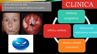 Papilomatosis respiratoria o laríngea recurrente _ recurrent