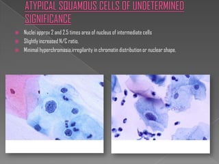    Nuclei approx 2 and 2.5 times area of nucleus of intermediate cells
   Slightly increased N/C ratio.
   Minimal hyperchromasia,irregilarity in chromatin distribution or nuclear shape.
 