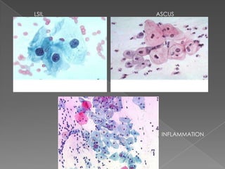 LSIL   ASCUS




        INFLAMMATION
 