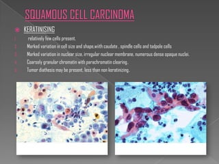     KERATINISING
1.     relatively few cells present.
2.    Marked variation in cell size and shape,wiith caudate , spindle cells and tadpole cells
3.    Marked variation in nuclear size, irregular nuclear membrane, numerous dense opaque nuclei.
4.    Coarsely granular chromatin with parachromatin clearing .
5.    Tumor diathesis may be present, less than non keratinizing.
 