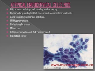    Cells in sheets and strips, cell crowding, nuclear overlap.
   Nuclear enlargement upto 3 to 5 times area of normal endocervical nuclei.
   Some variation in nuclear size and shape.
   Mild hyperchromasia
   Nucleoli may be present
   Mitosis rare
   Cytoplasm fairly abundant, N/C ratio increased
   Distinct cell border
 