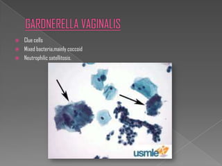    Clue cells
   Mixed bacteria,mainly coccoid
   Neutrophilic satellitosis.
 