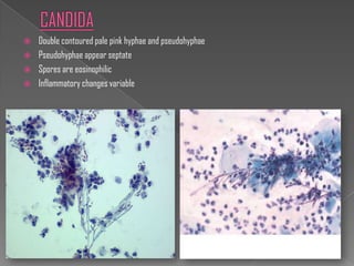    Double contoured pale pink hyphae and pseudohyphae
   Pseudohyphae appear septate
   Spores are eosinophilic
   Inflammatory changes variable
 