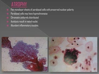    Flat monolayer sheets of parabasal cells with preserved nuclear polarity
   Parabasal cells may have hyprechromaisa
   Chromatin uniformly distributed
   Autolysis result in naked nuclei.
   Abundant inflammatory exudate.
 