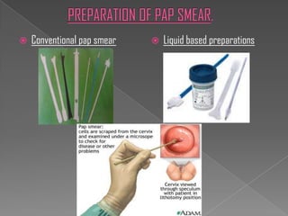    Conventional pap smear      Liquid based preparations
 