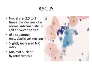 ASCUS
• Nuclei are 2.5 to 3
times the nucleus of a
normal intermediate Sq
cell or twice the size
• of a squamous
metaplastic cell nucleus
• Slightly increased N:C
ratio
• Minimal nuclear
hyperchromasia
 