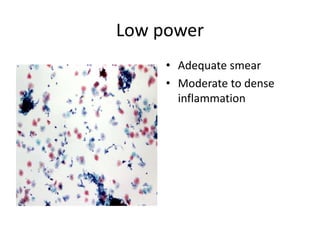 Low power
• Adequate smear
• Moderate to dense
inflammation
 