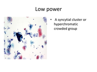 Low power
• A syncytial cluster or
hyperchromatic
crowded group
 