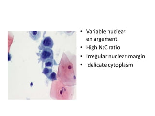 • Variable nuclear
enlargement
• High N:C ratio
• Irregular nuclear margin
• delicate cytoplasm
 