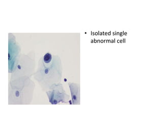 • Isolated single
abnormal cell
 